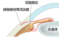 線維柱帯切開術(トラベクロトミー)