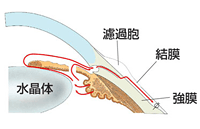 線維柱帯切除術(トラベクレクトミー)