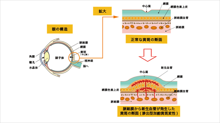 ARMD加齢黄斑変性とは