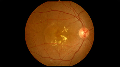 ARMD加齢黄斑変性とは