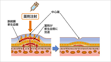 抗VEGF療法