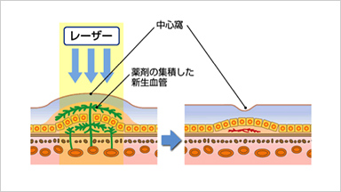 光線力学療法