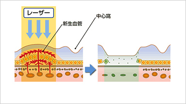 網膜光凝固術