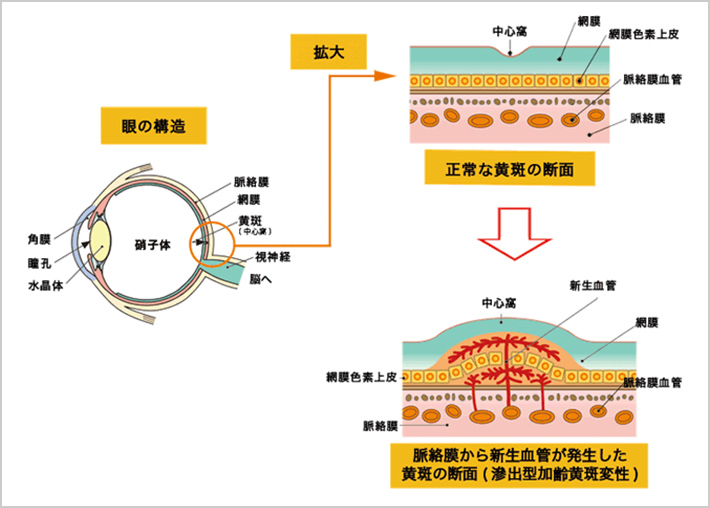 ARMD加齢黄斑変性とは