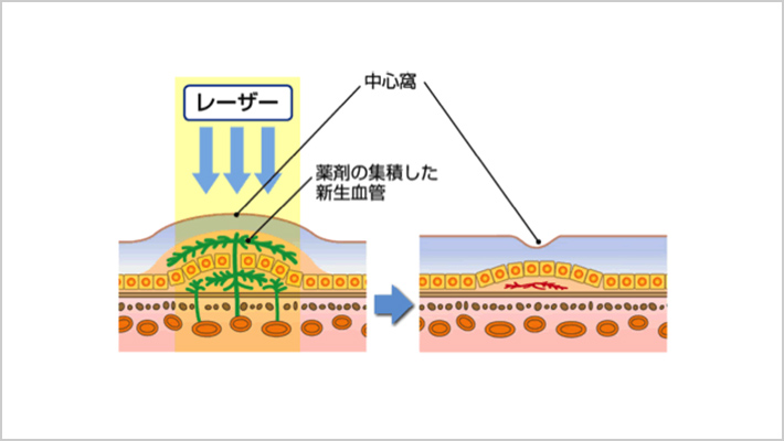 光線力学療法