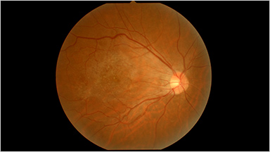 EPIRETINAL MEMBRANE 網膜前膜（黄斑上膜）