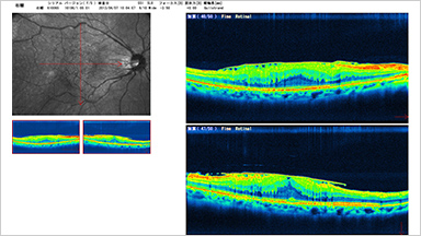 EPIRETINAL MEMBRANE 網膜前膜（黄斑上膜）