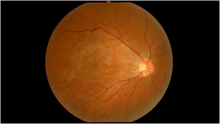 EPIRETINAL MEMBRANE 網膜前膜（黄斑上膜）