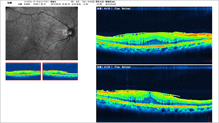 EPIRETINAL MEMBRANE 網膜前膜（黄斑上膜）