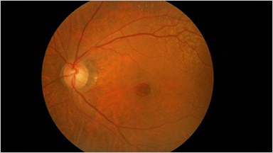 MACULAR HOLE 黄斑円孔