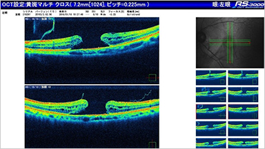 MACULAR HOLE 黄斑円孔