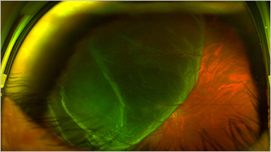 RETINAL DETACHMENT 網膜剥離