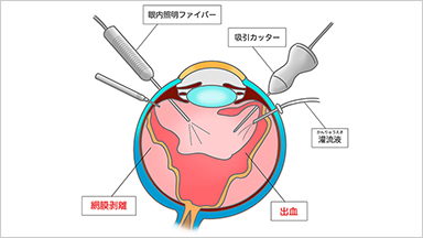 RETINAL DETACHMENT 網膜剥離