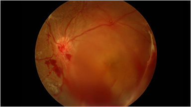 VITREOUS HEMORRHAGE 硝子体出血