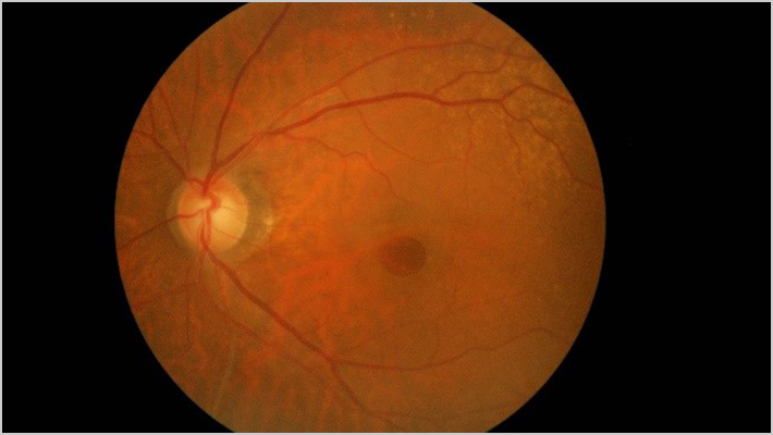 MACULAR HOLE 黄斑円孔