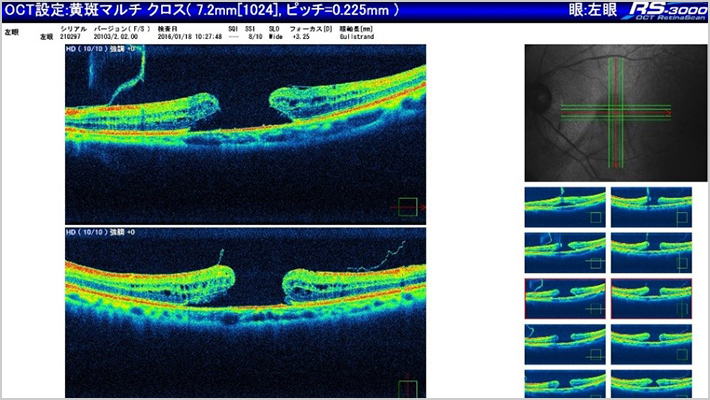 MACULAR HOLE 黄斑円孔