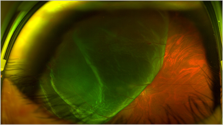 RETINAL DETACHMENT 網膜剥離