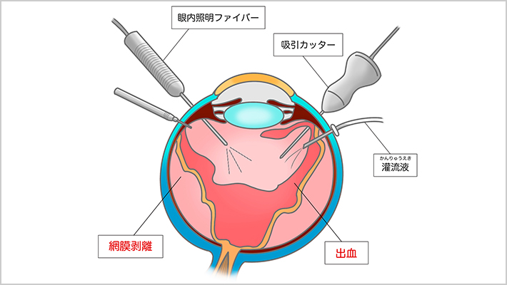 RETINAL DETACHMENT 網膜剥離