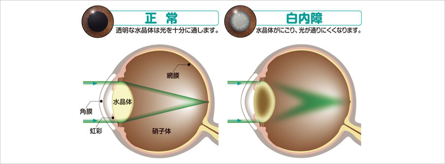 COTARACT白内障とは