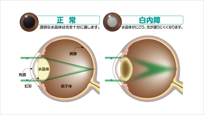 COTARACT白内障とは