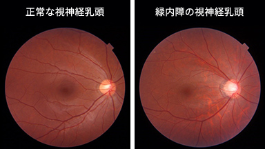 正常な視神経乳頭緑内障の視神経乳頭