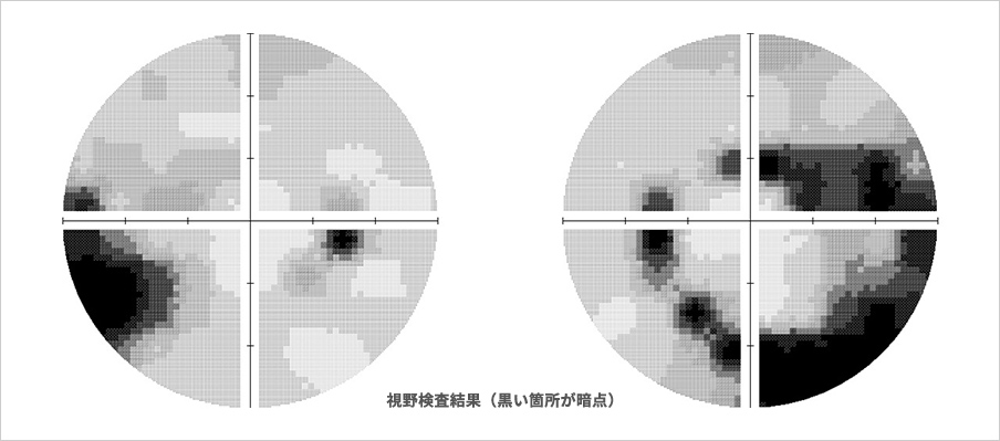 視野検査結果（黒い箇所が暗点）