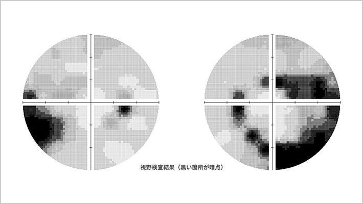 視野検査結果(黒い箇所が暗点)