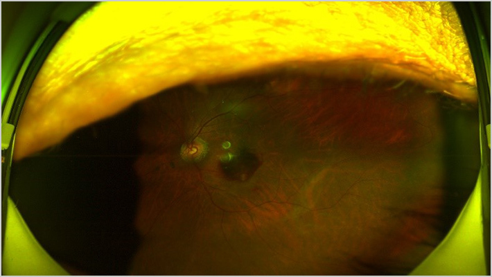 RETINAL MICROANEURYSM網膜細動脈瘤