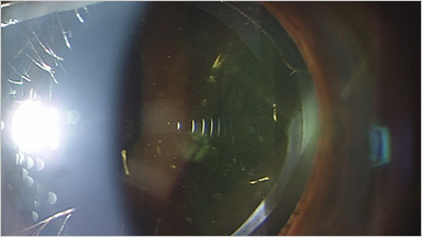 PREMIUM01選定療養対象のプレミアム眼内レンズ