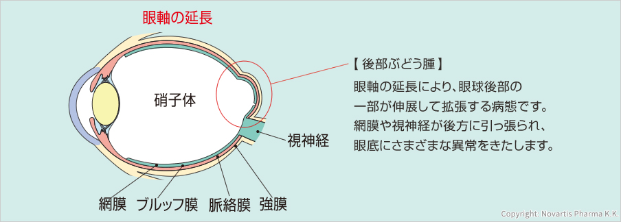 眼軸の延長硝子体視神経網膜 ブルッフ膜 脈絡膜 強膜【後部ぶどう腫】眼軸の延長により、眼球後部の一部が伸展して拡張する病態です。網膜や視神経が後方に引っ張られ、眼底にさまざまな異常をきたします。