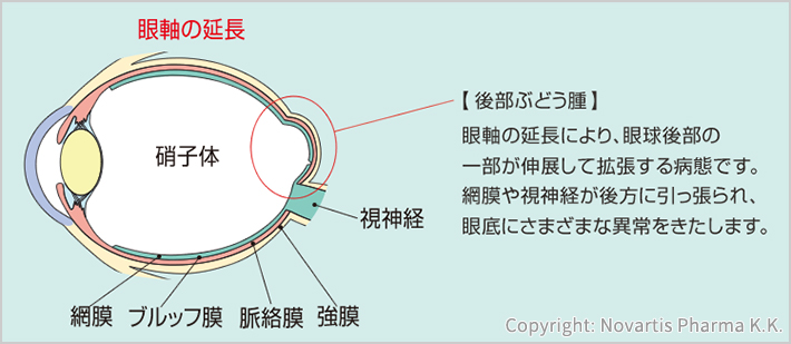 眼軸の延長硝子体視神経網膜 ブルッフ膜 脈絡膜 強膜【後部ぶどう腫】眼軸の延長により、眼球後部の一部が伸展して拡張する病態です。網膜や視神経が後方に引っ張られ、眼底にさまざまな異常をきたします。