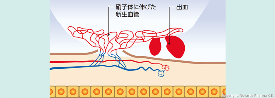 硝子体に伸びた新生血管出血Copyright: Novartis Pharma K.K.