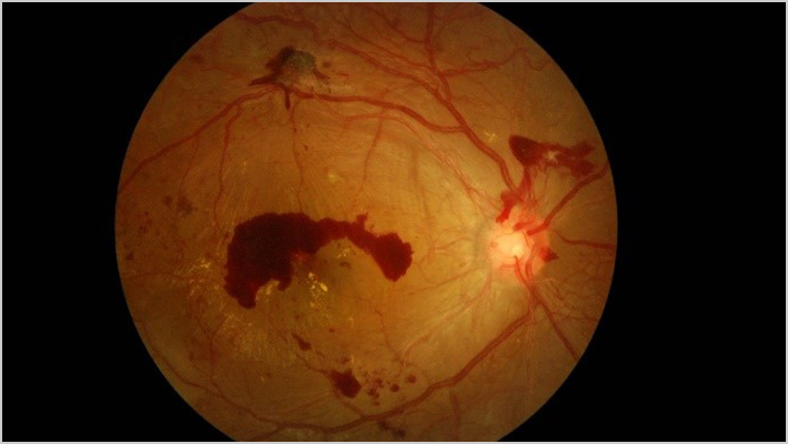 第3段階増殖前網膜症
