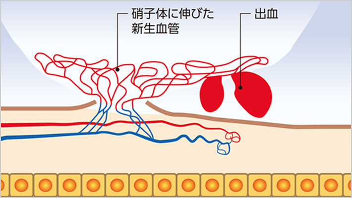 硝子体に伸びた新生血管出血Copyright: Novartis Pharma K.K.