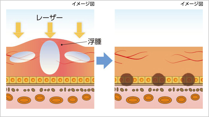 03. 網膜光凝固術