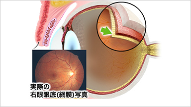 SURGERY網膜硝子体手術