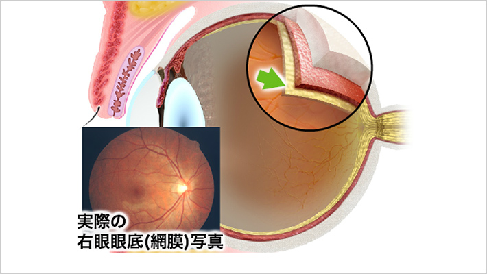 SURGERY網膜硝子体手術