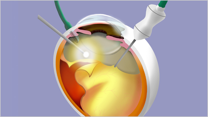 SURGERY網膜硝子体手術